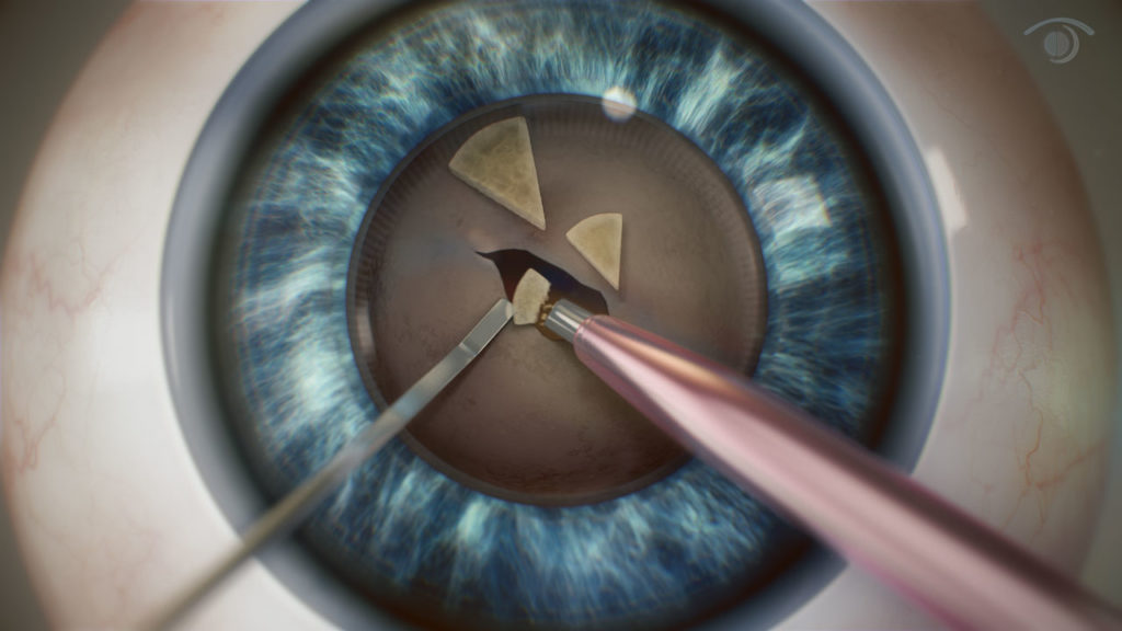 surgery in human eye